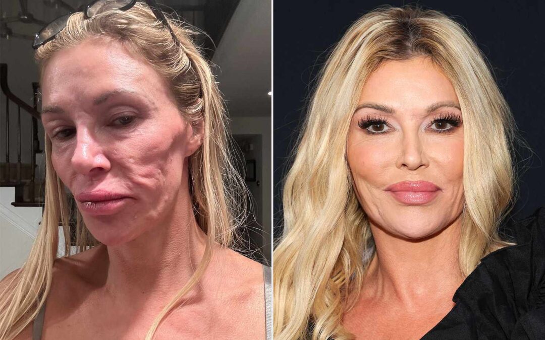 Brandi Glanville Says She’s Been ‘Hiding Out’ Due to ‘Cruel Comments on My Appearance’ amid Facial Disfigurement