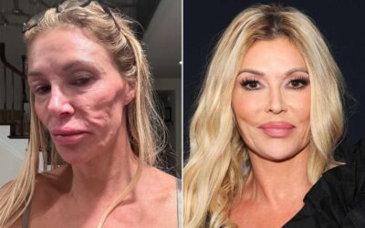 Brandi Glanville Says She’s Been ‘Hiding Out’ Due to ‘Cruel Comments on My Appearance’ amid Facial Disfigurement