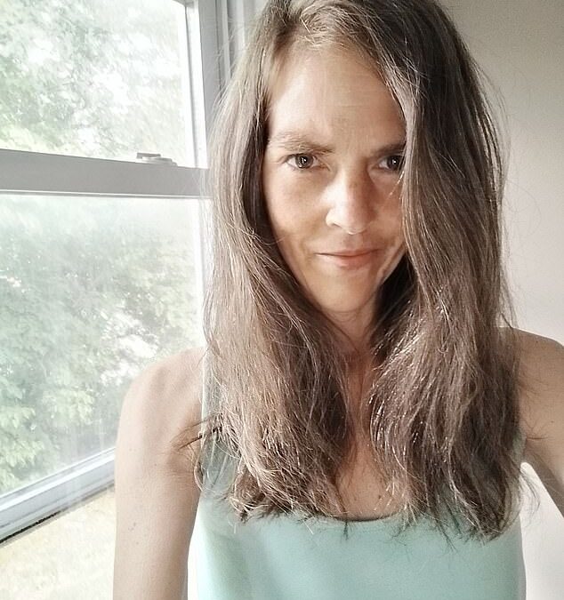 I was left with horrific fourth-degree burns after trying habit of 17m Americans for first time